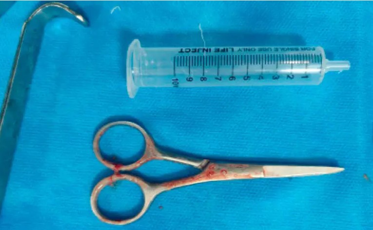 കുതിരവട്ടത്ത് രോഗി കത്രിക വിഴുങ്ങി; മെഡി. കോളജിൽനിന്ന് പുറത്തെടുത്തു